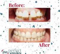 Invisalign-Upper-West-Side-NYC-Before-and-After-16