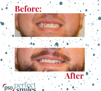 Invisalign-Upper-West-Side-NYC-Before-and-After-22
