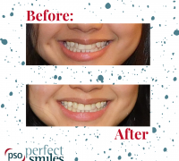 Invisalign-Upper-West-Side-NYC-Before-and-After-32