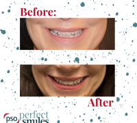 Invisalign-Upper-West-Side-NYC-Before-and-After-33