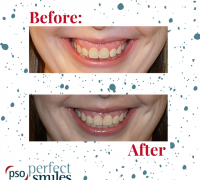 Invisalign-Upper-West-Side-NYC-Before-and-After-34