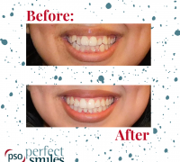 Invisalign-Upper-West-Side-NYC-Before-and-After-35