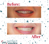 Invisalign-Upper-West-Side-NYC-Before-and-After-40