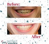 Invisalign-Upper-West-Side-NYC-Before-and-After-41