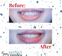 Invisalign-Upper-West-Side-NYC-Before-and-After-43