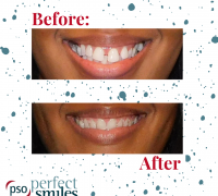 Invisalign-Upper-West-Side-NYC-Before-and-After-44