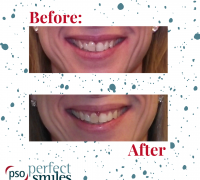 Invisalign-Upper-West-Side-NYC-Before-and-After-47