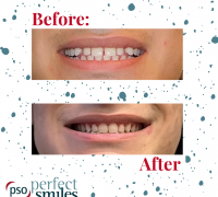 Invisalign-Upper-West-Side-NYC-Before-and-After-48