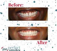 Invisalign-Upper-West-Side-NYC-Before-and-After-7