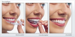 invisalign upper west side